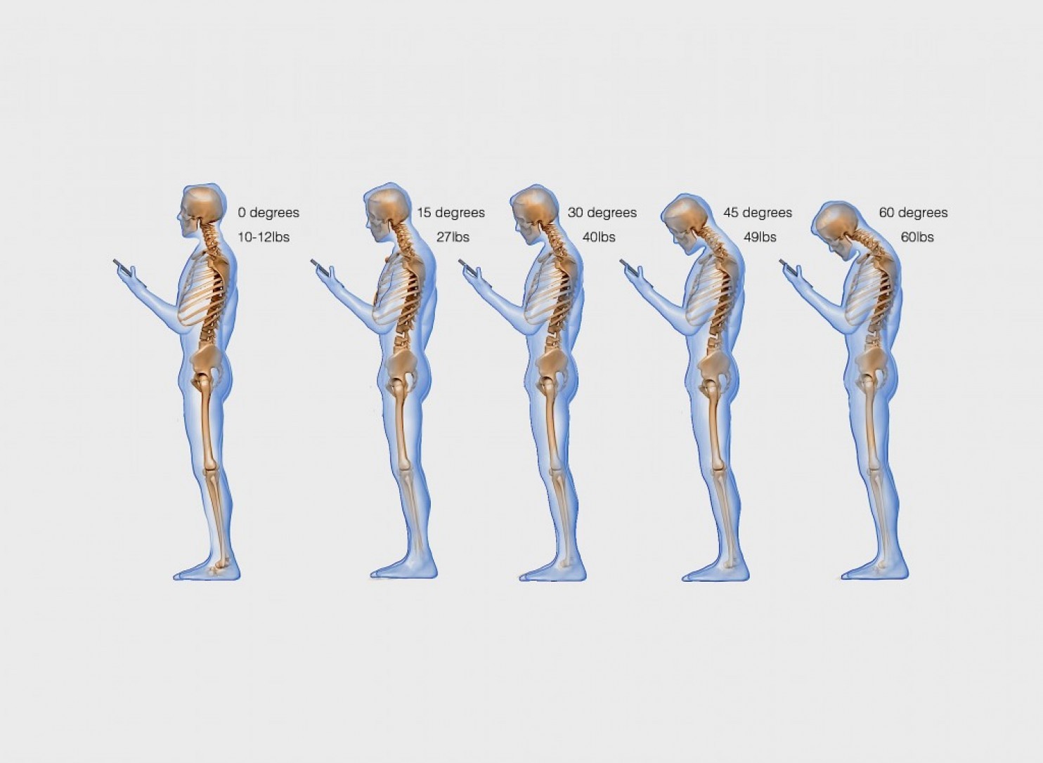 Американський лікар дослідив, що смартфони впливають на викривлення хребта